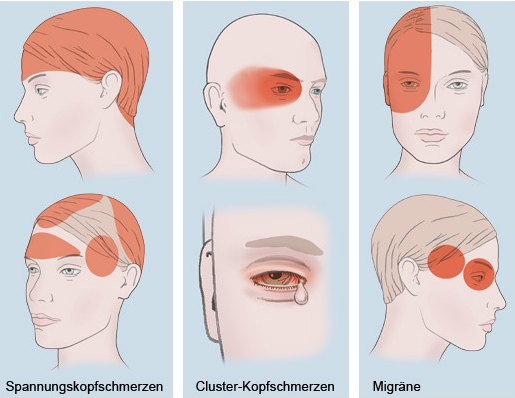 Veranschaulichung unterschiedlicher Kopfschmerztypen